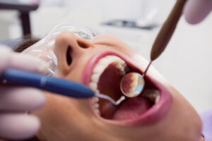 How Much Does a Filling Cost at a Private Dentist in the UK