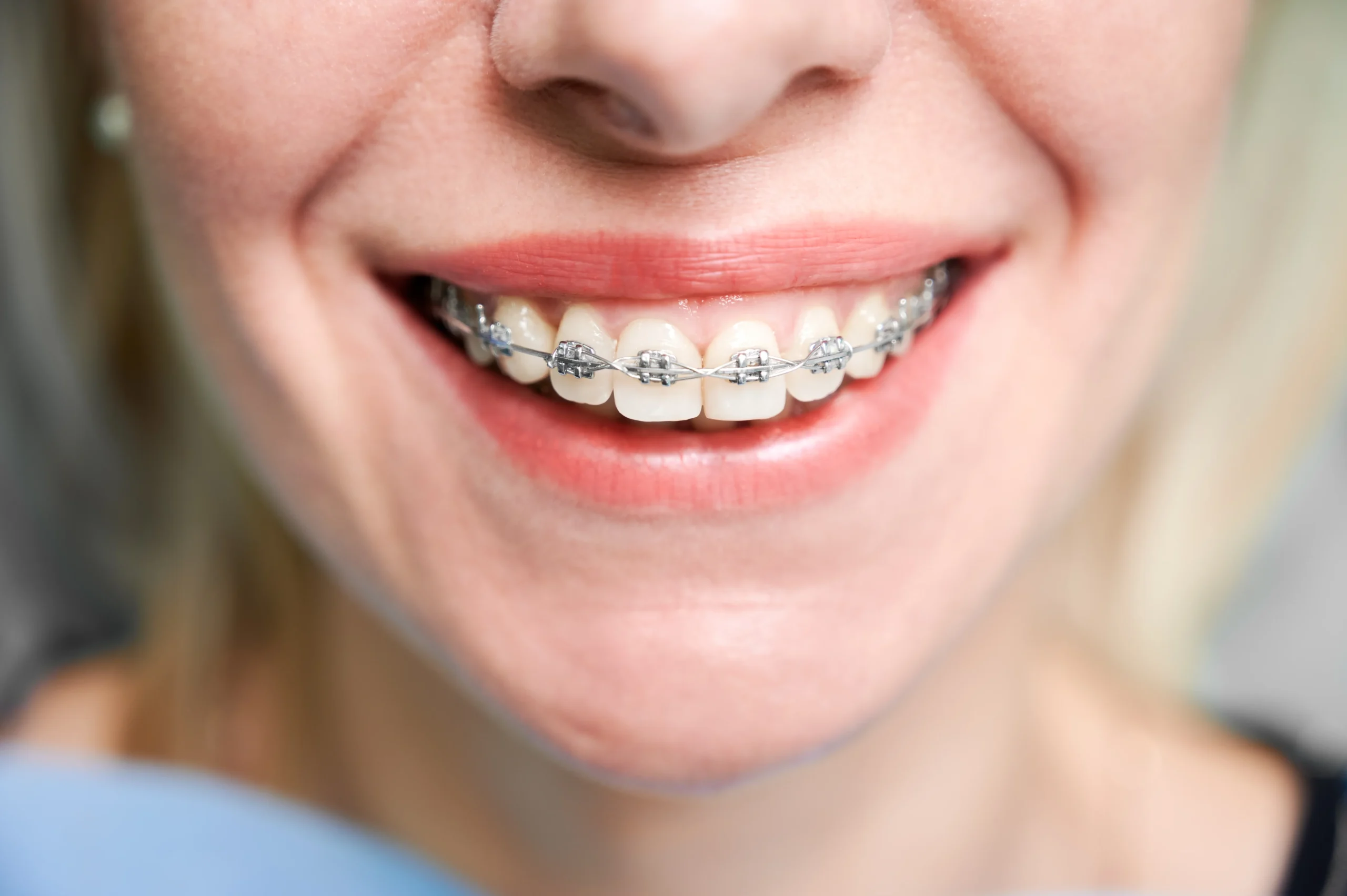 teeth whitening with braces