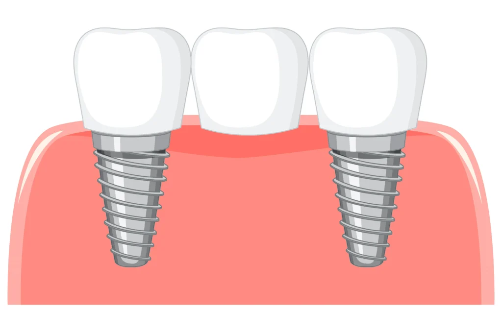 Implant-supported bridge showing a common type of dental implant replacing multiple missing teeth.