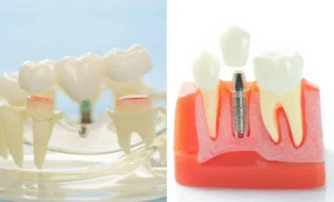 Image showing how a dental bridge is anchored to neighbouring teeth vs how an implant is embedded in the jawbone.