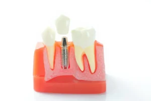 Cross-section of jaw with endosteal implant, the most common type of dental implant placed in bone.